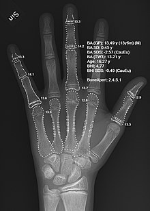 X-ray of a hand with automatic bone age calculation.jpg